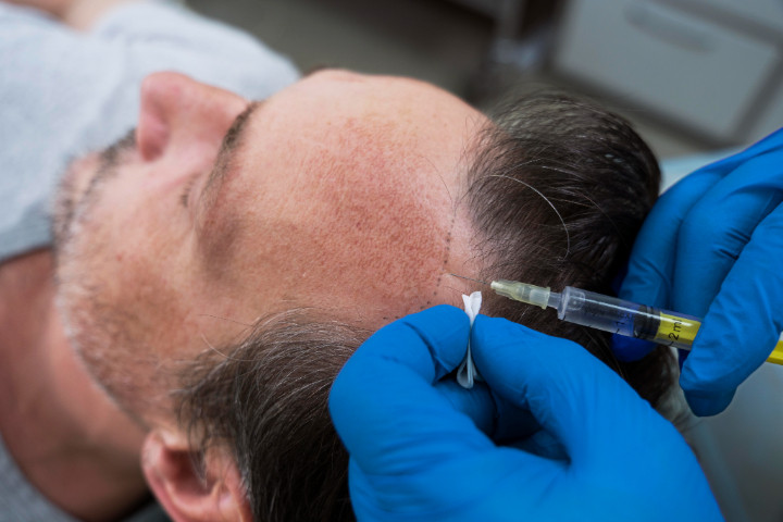 PRP Saç - Platelet Rich Plasma Uygulaması